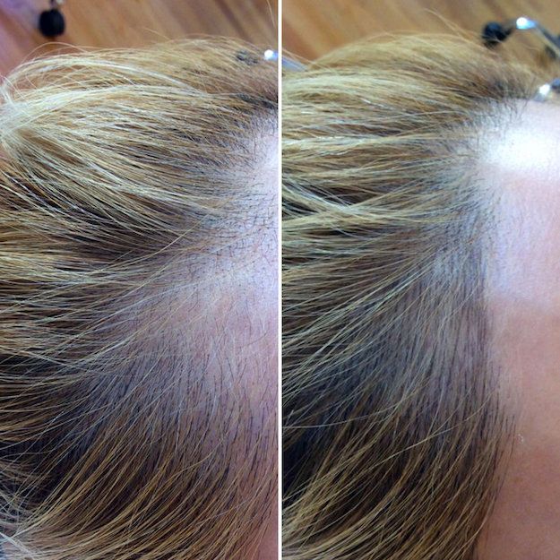 Scalp micropigmentation before and after female hairline tattoo sydney   Novoscalp  SMP Clinics Australia