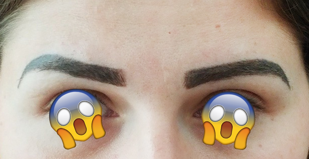 Eyebrow Tattoo Removal Melbourne
