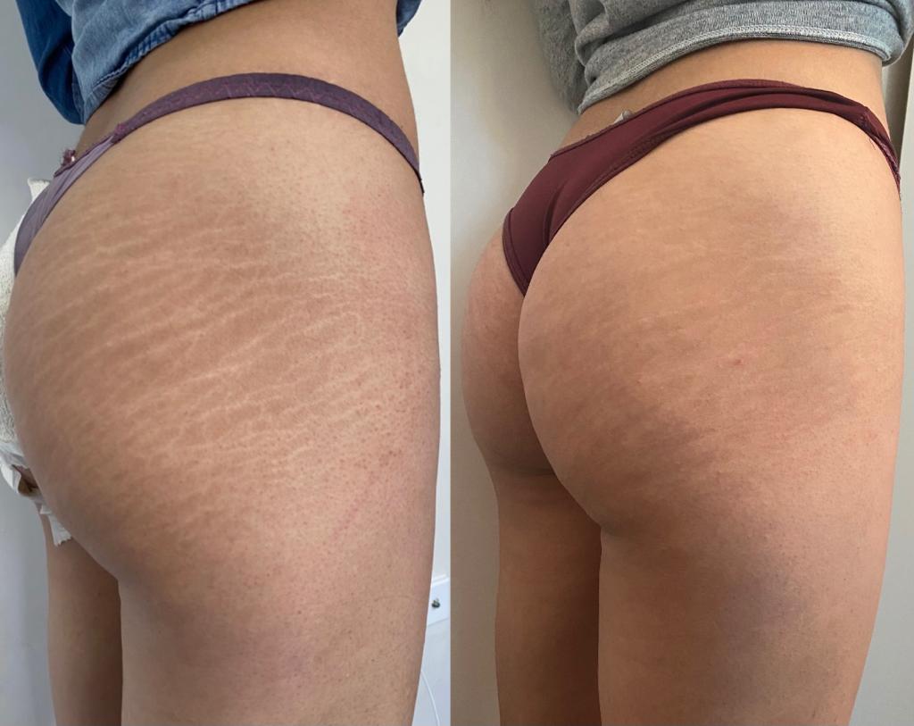 Inkless Stretch Mark Removal
