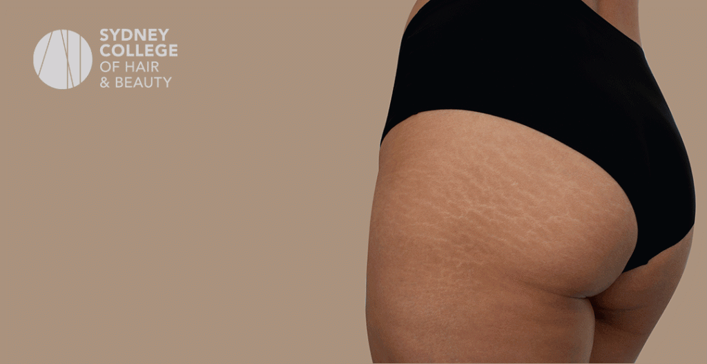 Inkless Stretch mark Removal